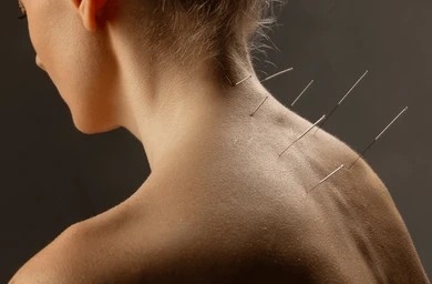 How Dry needle works : benefits and what to expect