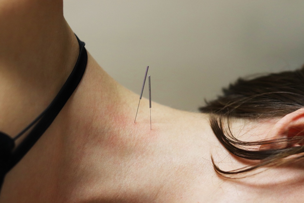 Benefits of Dry Needling