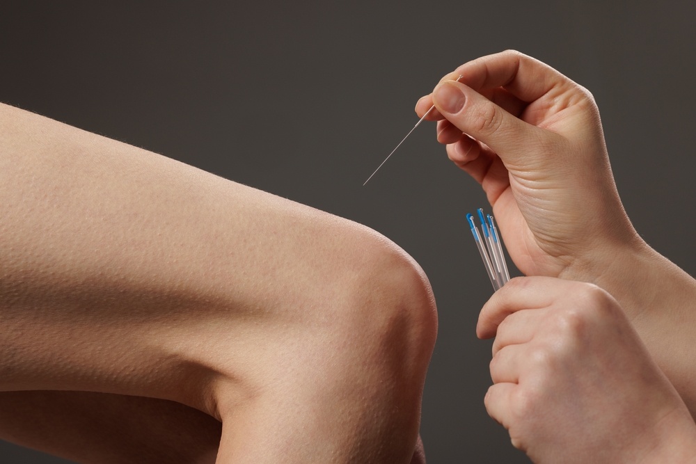 How Dry Needling Supports Post-Surgery Physiotherapy