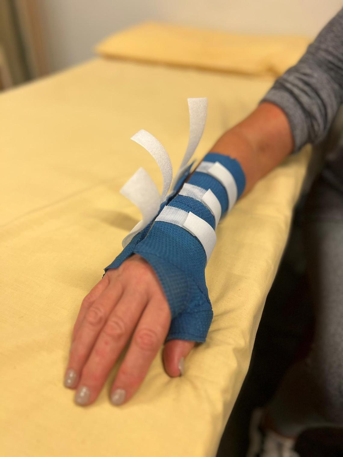 Close-up of a hand wearing a therapeutic splint with supportive straps